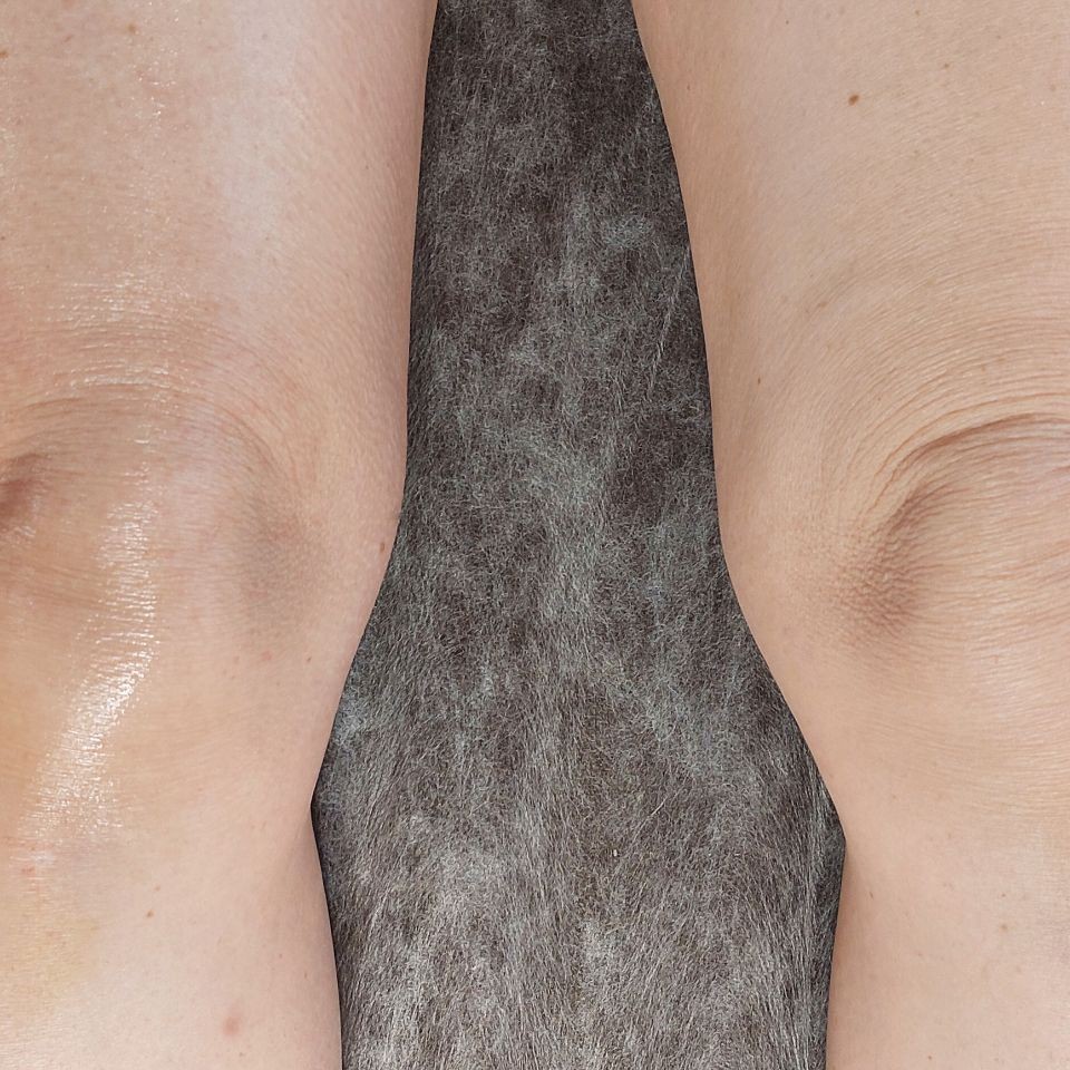 Омоложение (подтяжка) колени