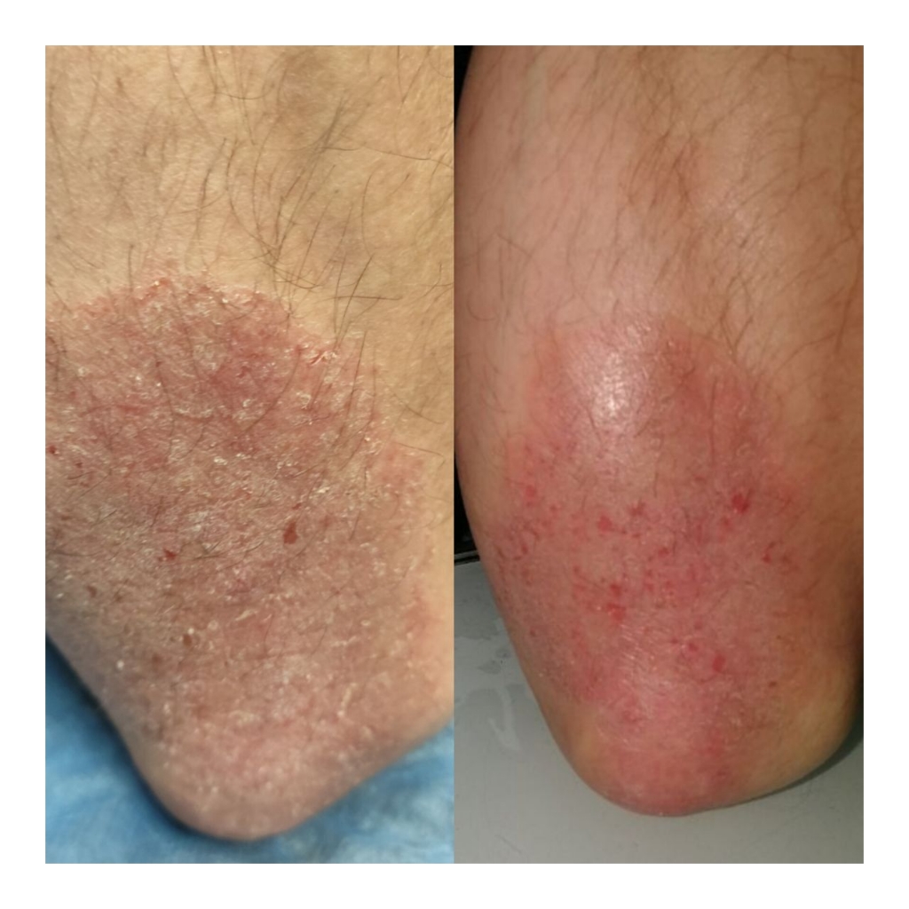 Лечение псориаза (зависит от размера)