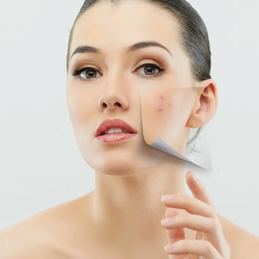 Карбокситерапия Anti-Acne
