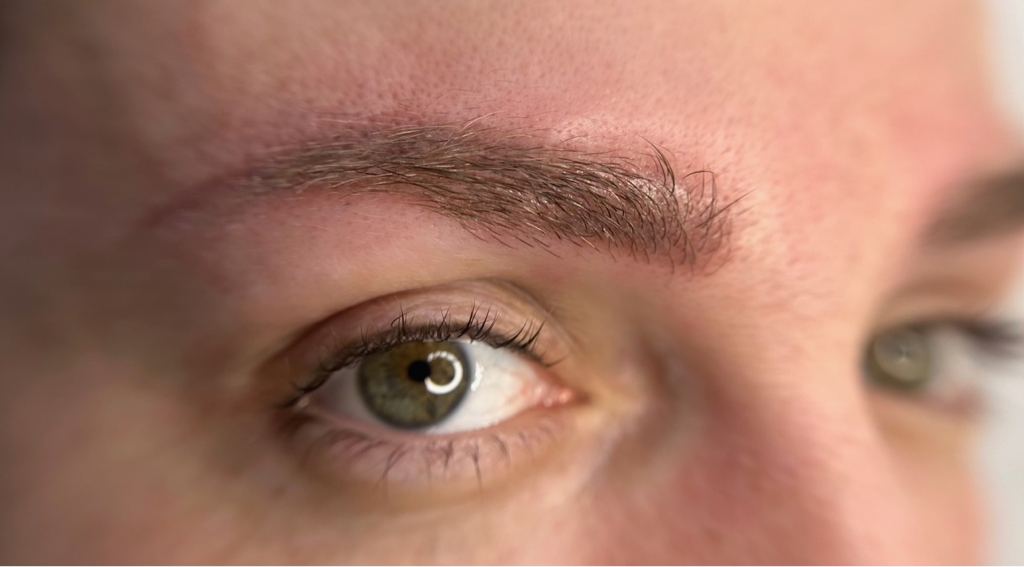 Удаление ремувером тату татуажа