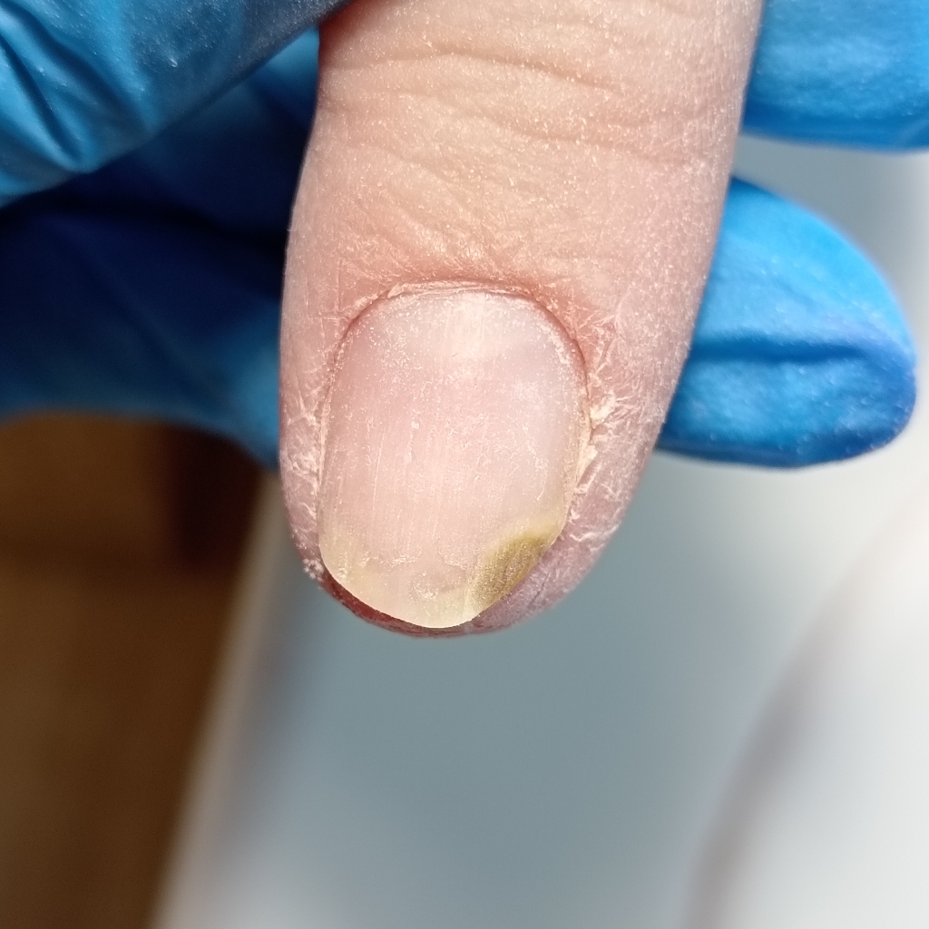 Зачистка онихолизиса