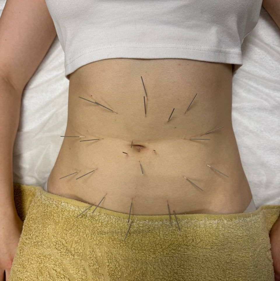 Остеоакупунктура