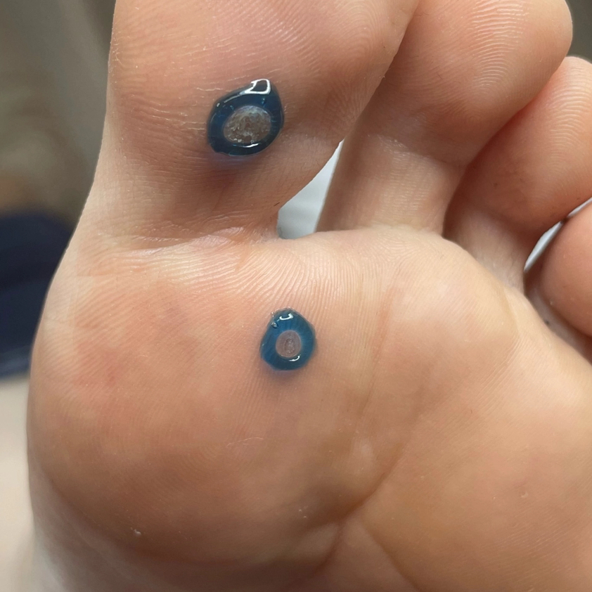 Удаление бородавок (первичный прием) 1-3 шт/700; от 5 шт/1000.