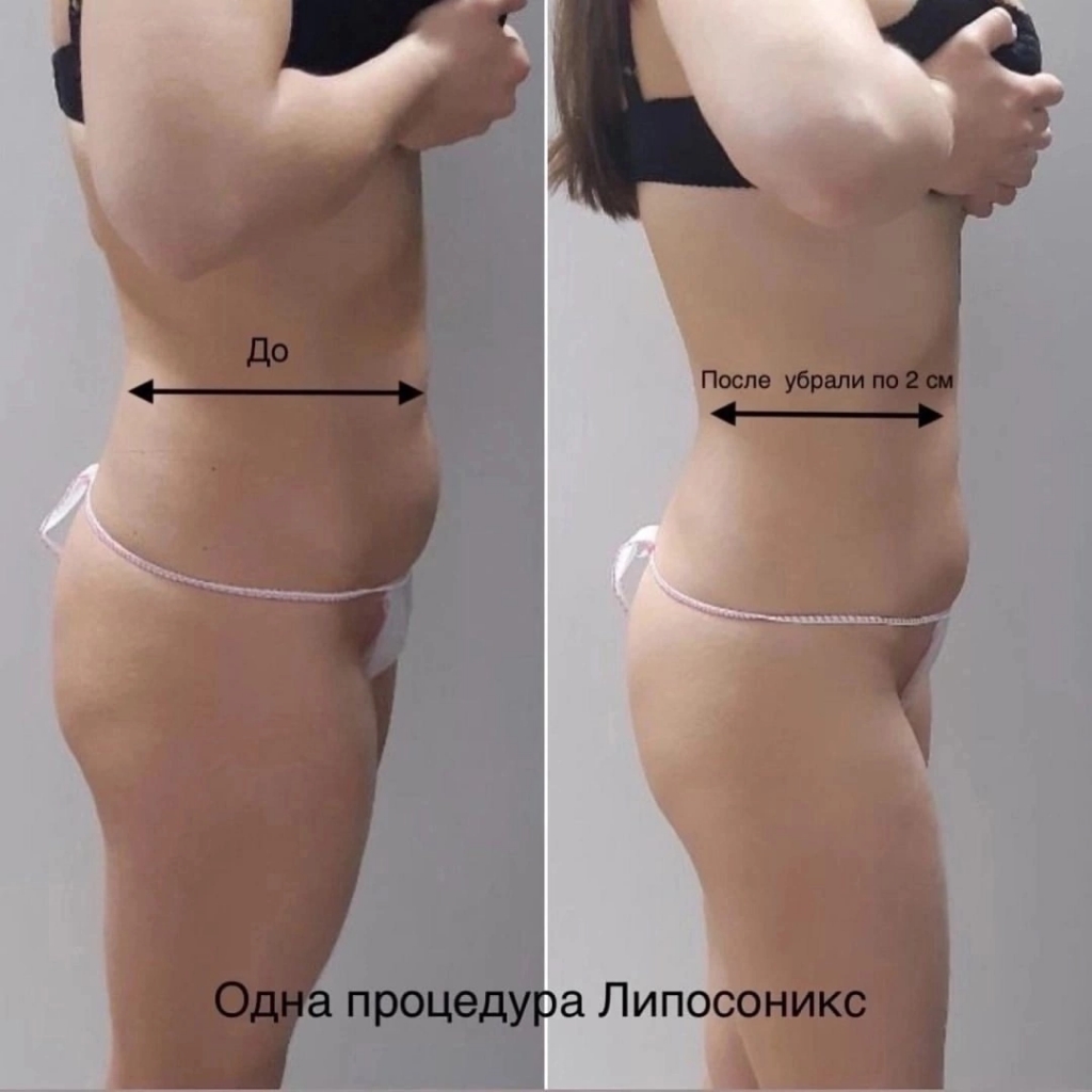 Консультация липосоникс+процедура