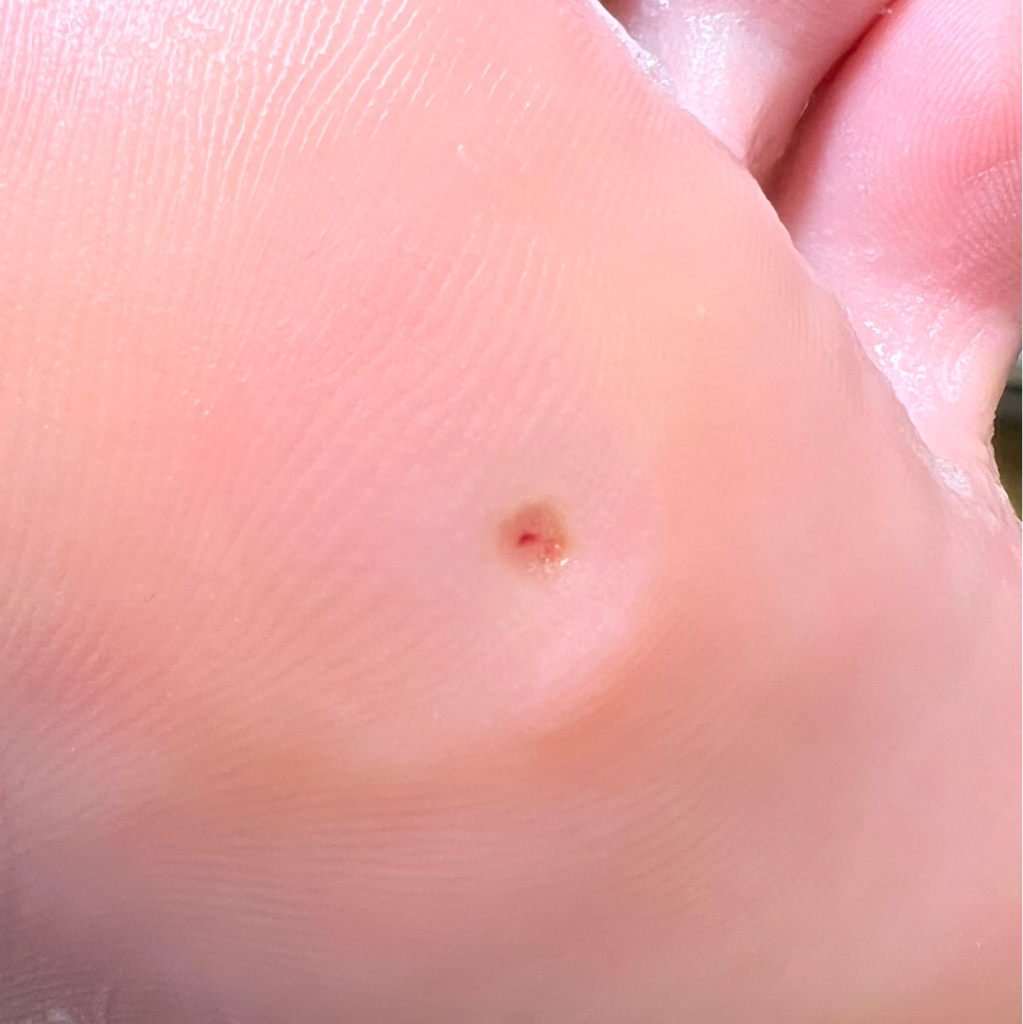 Обработка стержневых мозолей