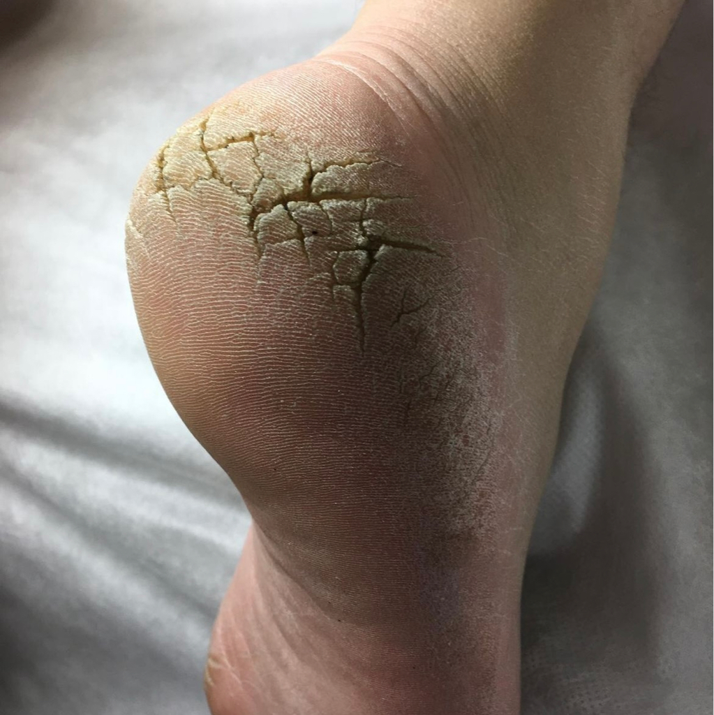 Обработка трещин на стопе