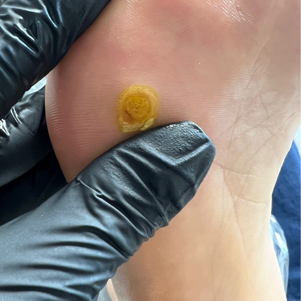 Удаление бородавки азотной кислотой