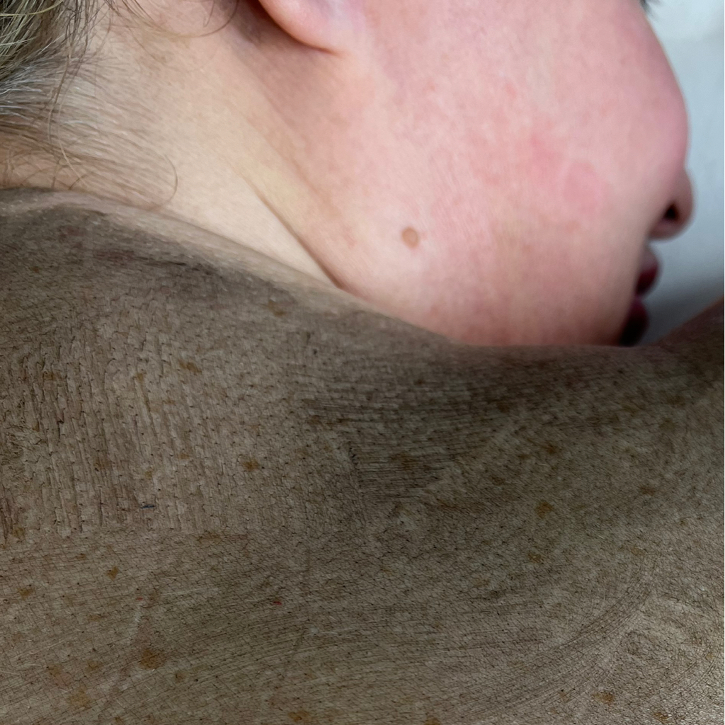 Карбоновый пилинг - воротниковая зона