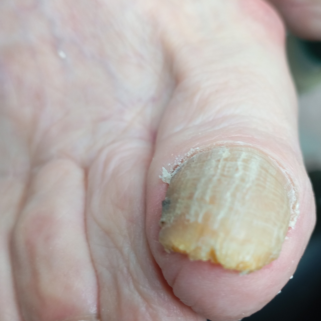 Обработка утолщеной ногтевой пластины