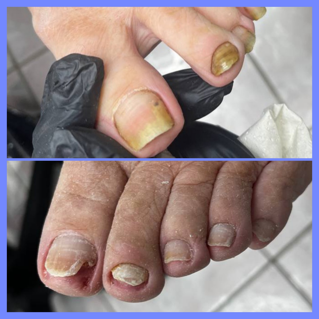 Онихолизис (травматический)