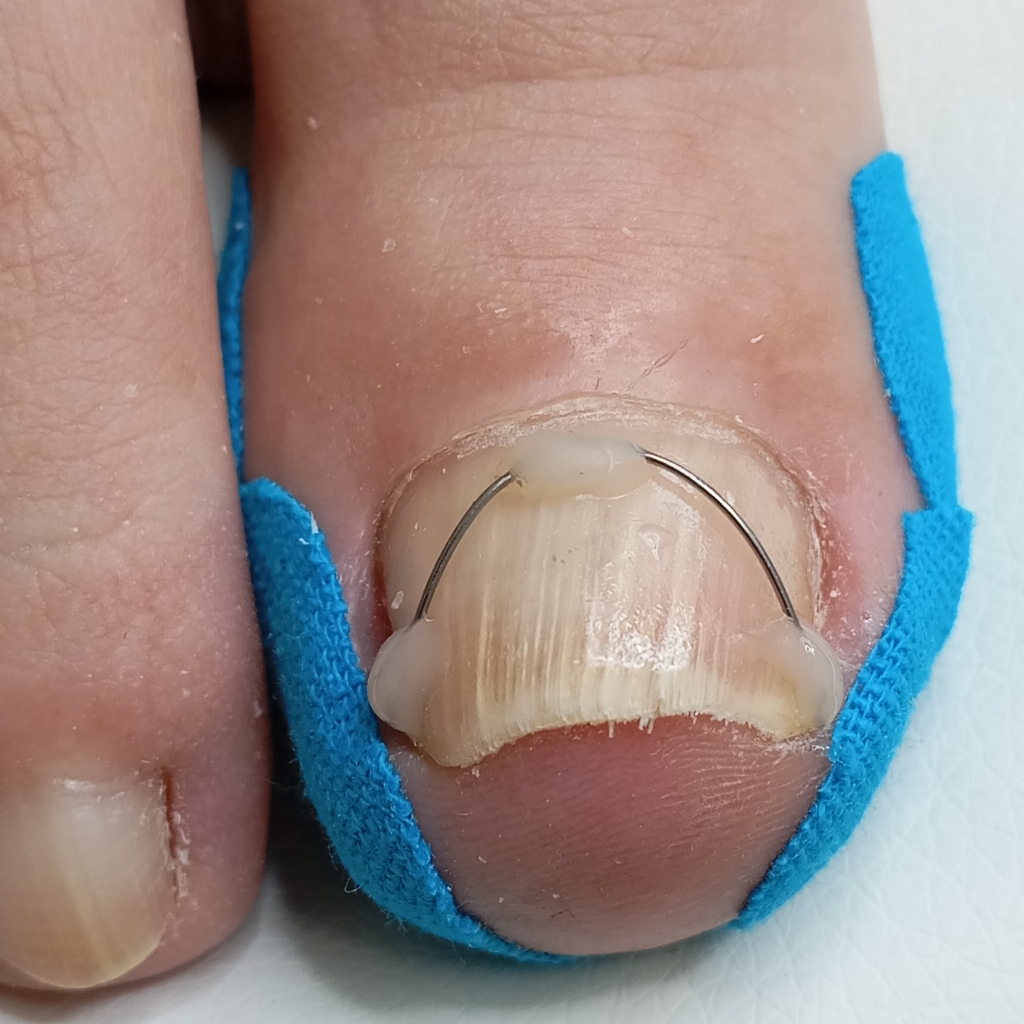 Фиксация корректирующей системы NiTi