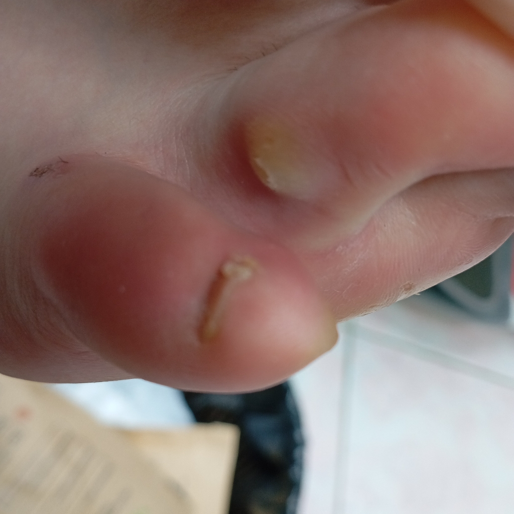 Работа с мозолями Мозоли между пальцев