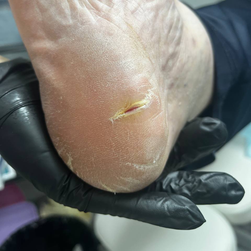 Педикюр. Подообработка стопы. Трещины