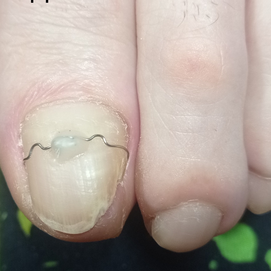 Фиксация корректирующей системы 3ТО