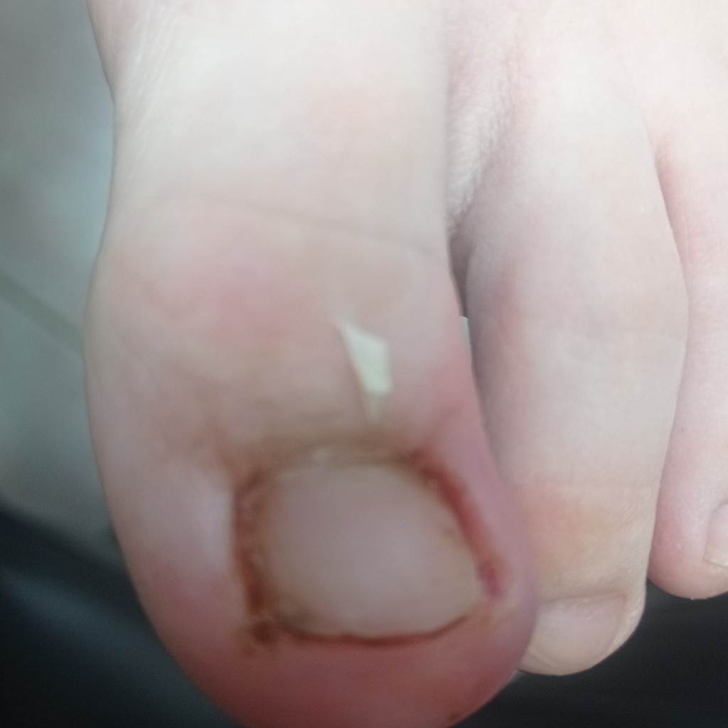 Работа с проблемным ногтем/вросший без воспаления