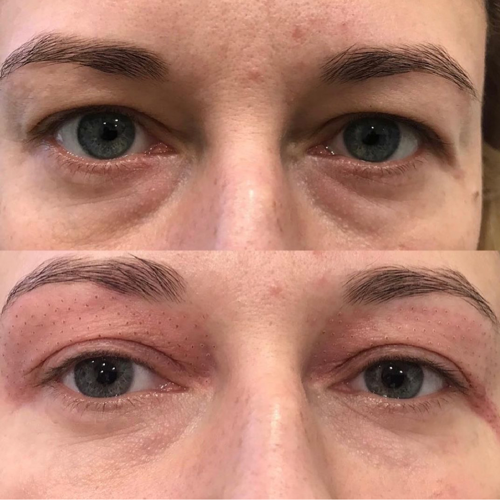 Лифтинг век