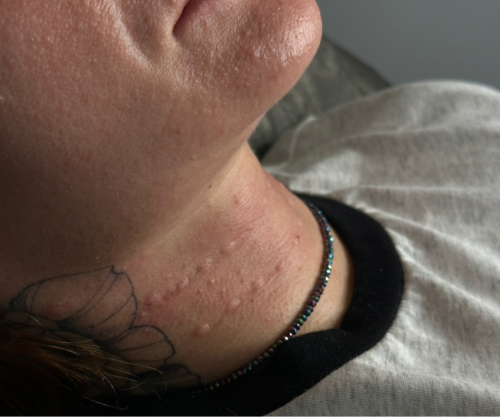 Кольца Венеры (поперечные морщины шеи)