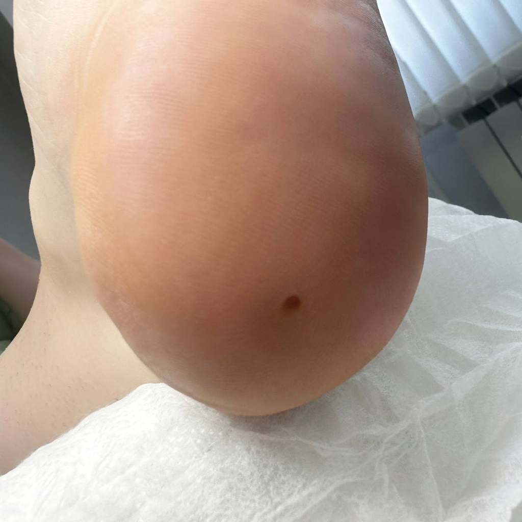 Парамедицинский педикюр