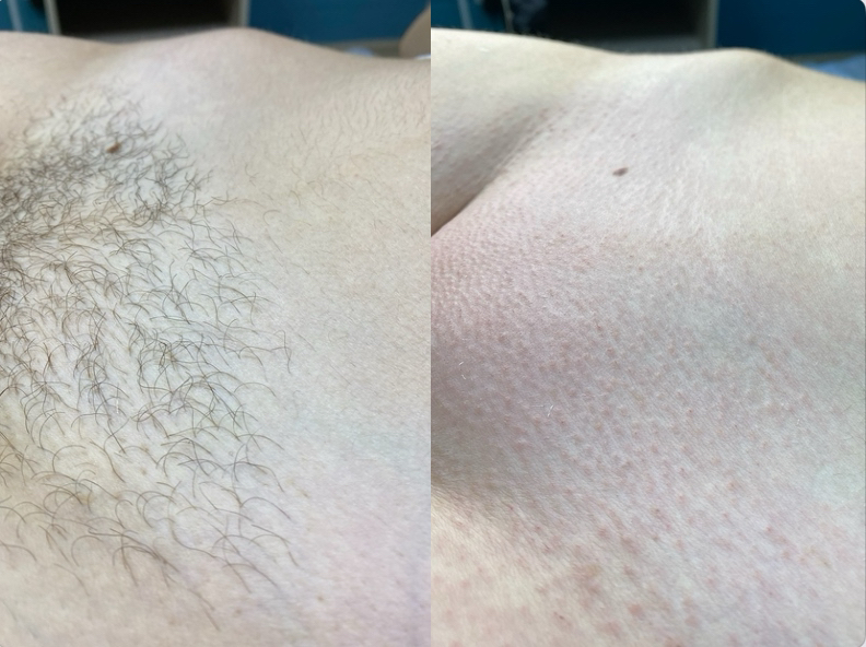 Глубокое бикини