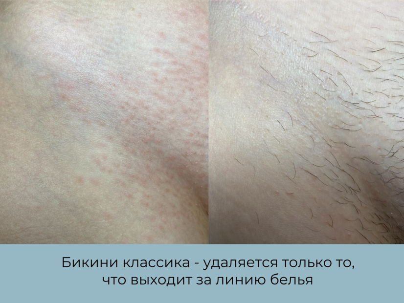 Бикини классика