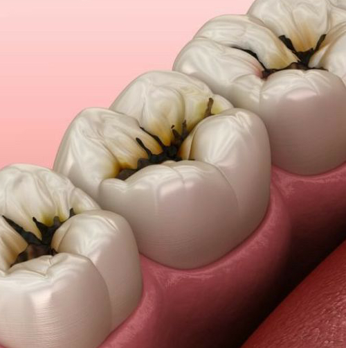 Лечение кариеса