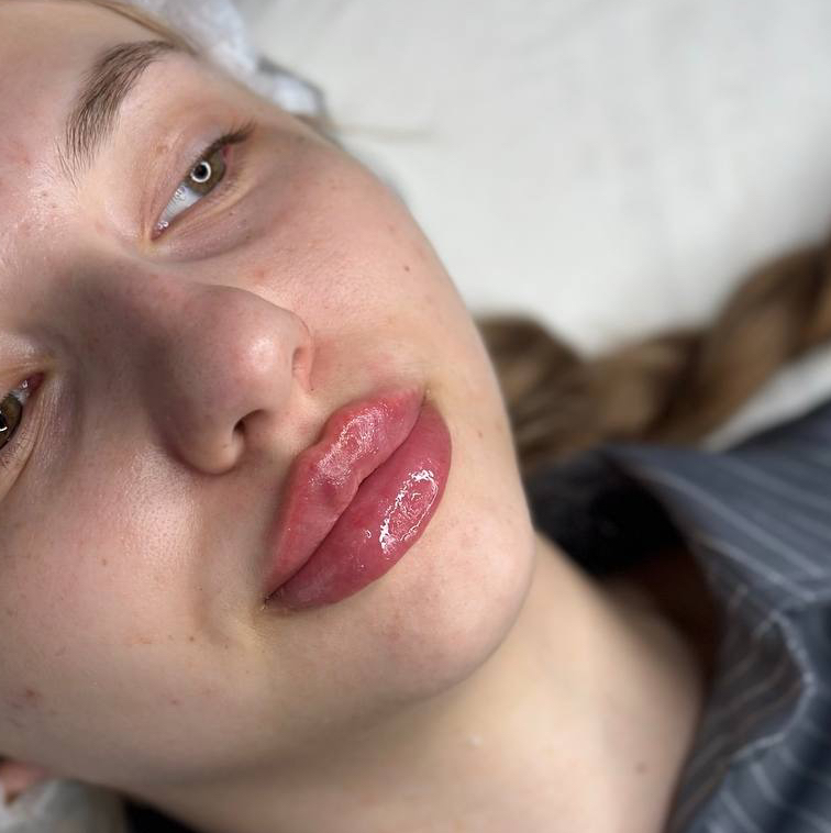 Контурная пластика  Губы Лицо Тело