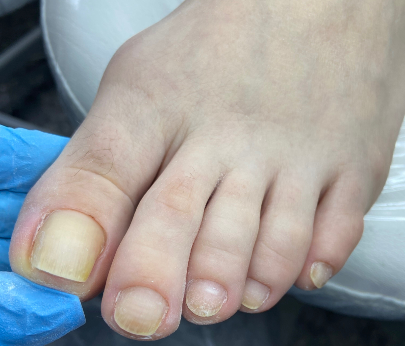 Работа с вросшим ногтем