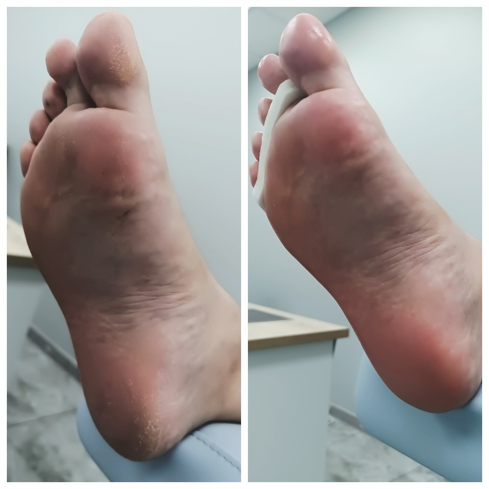 Педикюр стопы