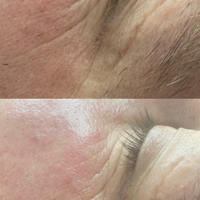 Неинвазивная карбокситерапия курс 5 процедур