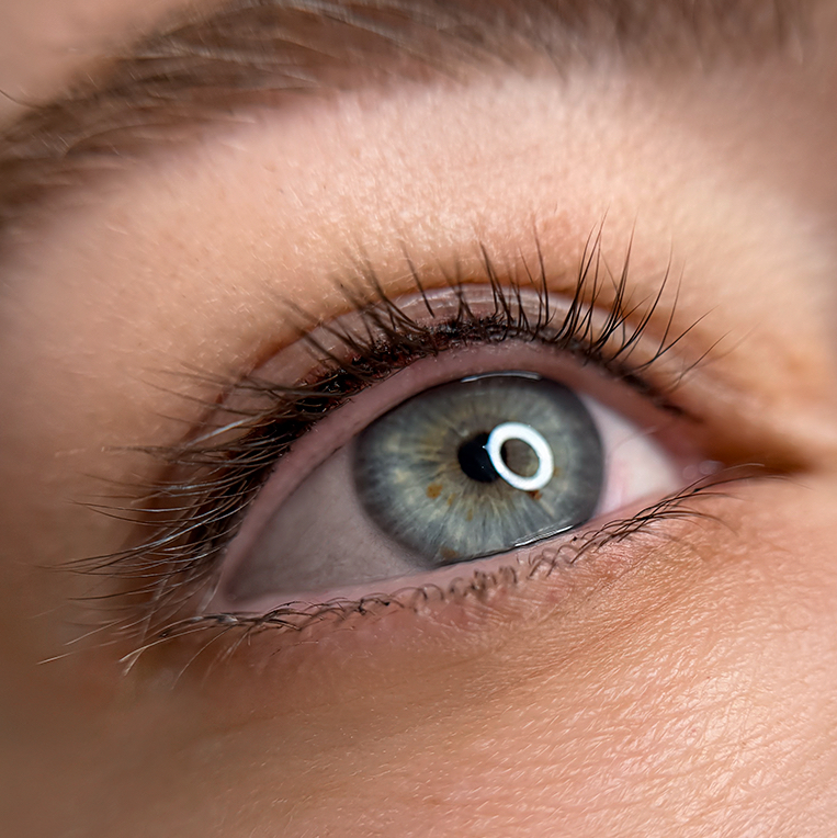 Коррекция пм межресничка не позже 2-х месяцев