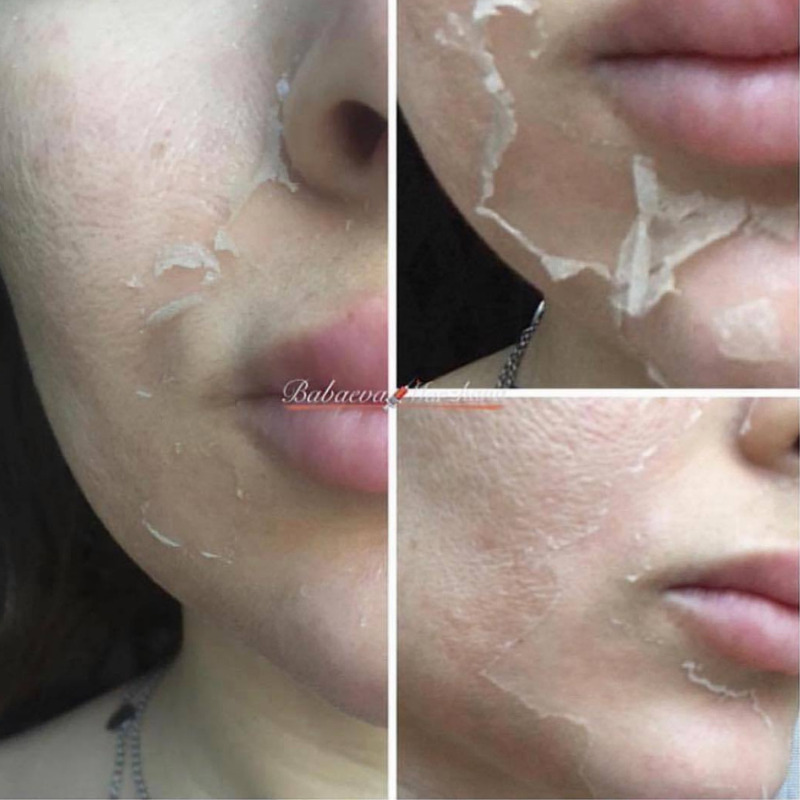 Пилинг ретиноловый (жёлтый) Medi+derma