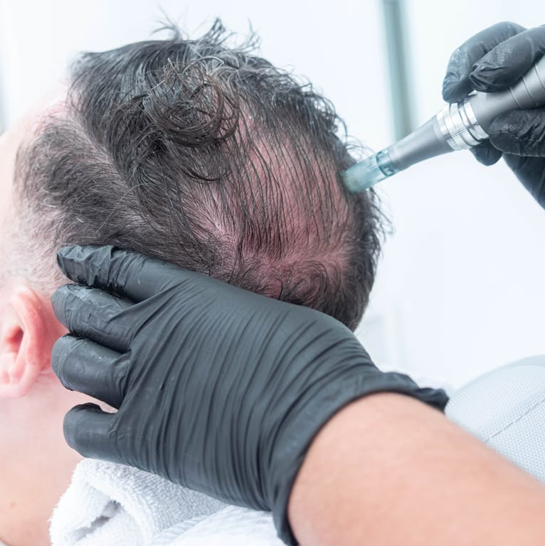 Scalp Microneedling