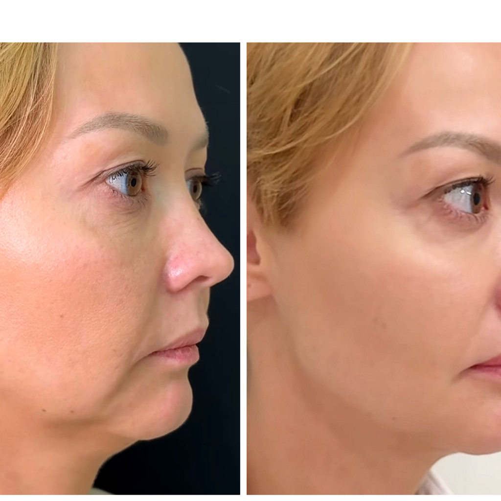 LASER ENDO-LIFT (1 zone ) LIPOSUCTION- LASER