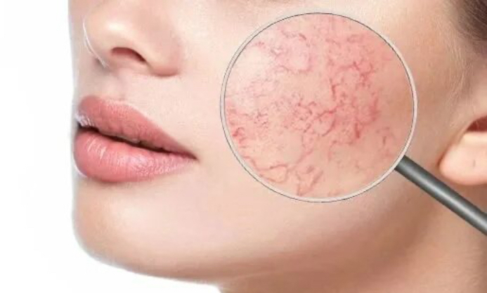 IPL-терапия применяется для удаления пигментаций, акне и сосудов - купероза, розацеа, сосудистой сетки.+все сезонный пилинг