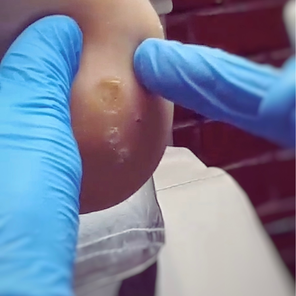 Обработка подошвенной бородавки