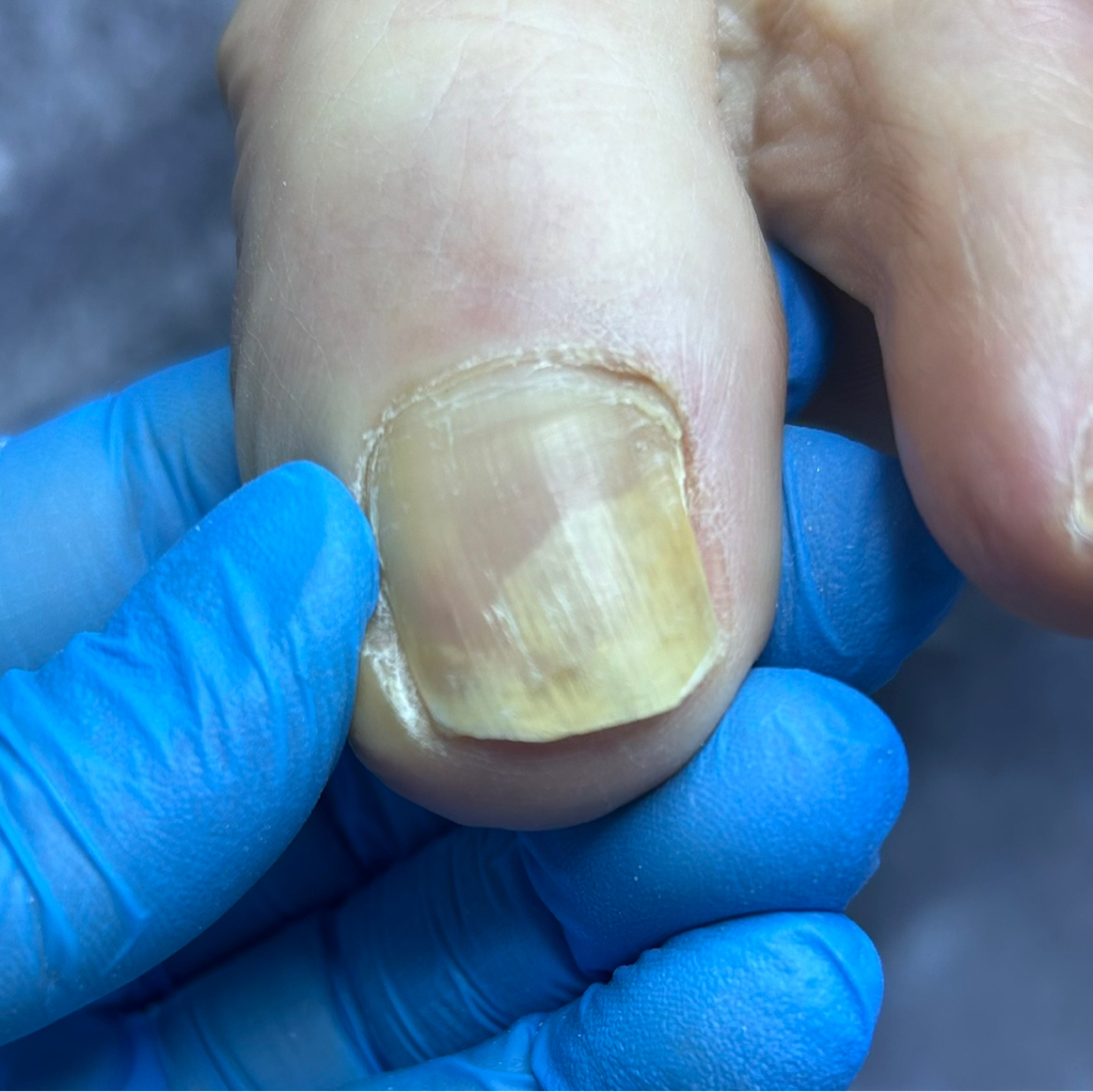 Обработка онихолизиса