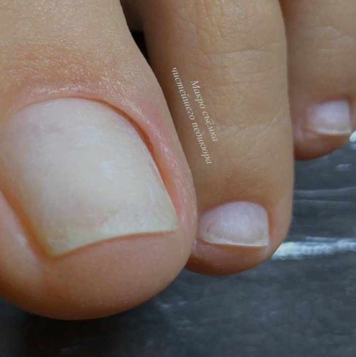 Гигиеническая обработка пальцев ног (без покрытия)