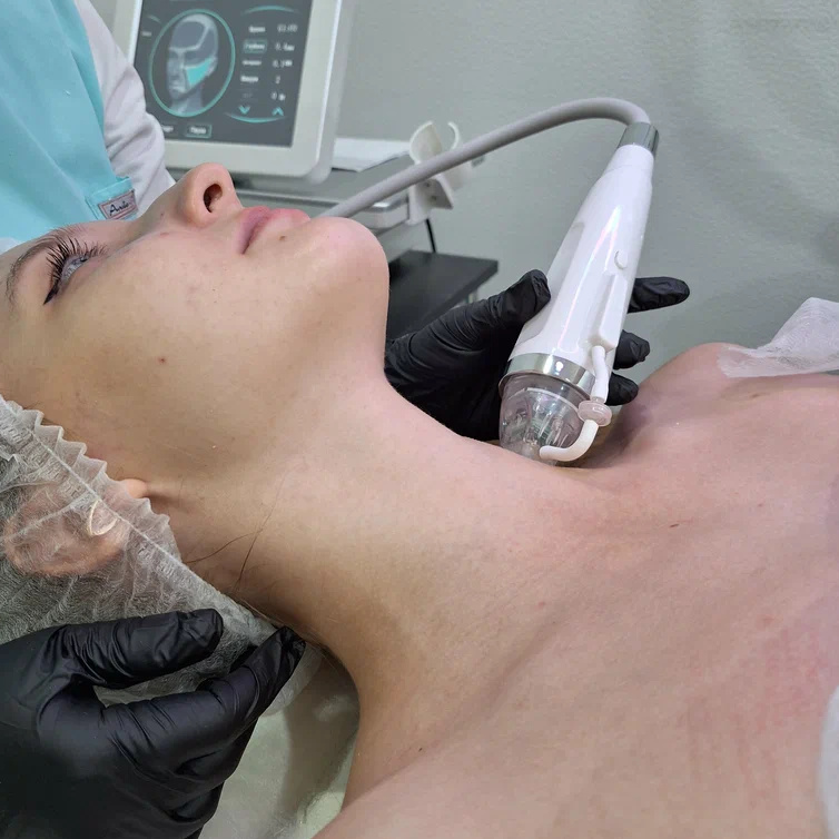 Микроигольчатый RF лифтинг  шея+декольте