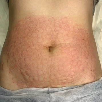 Микроигольчатый RF лифтинг  живот