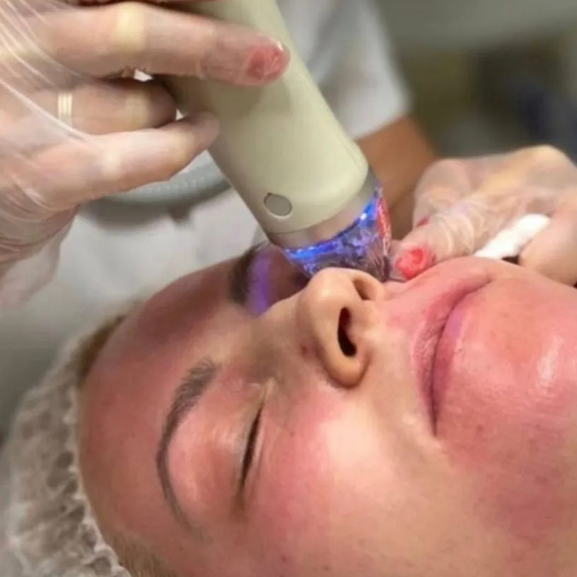 Микроигольчатый RF лифтинг лицо+шея+декольте