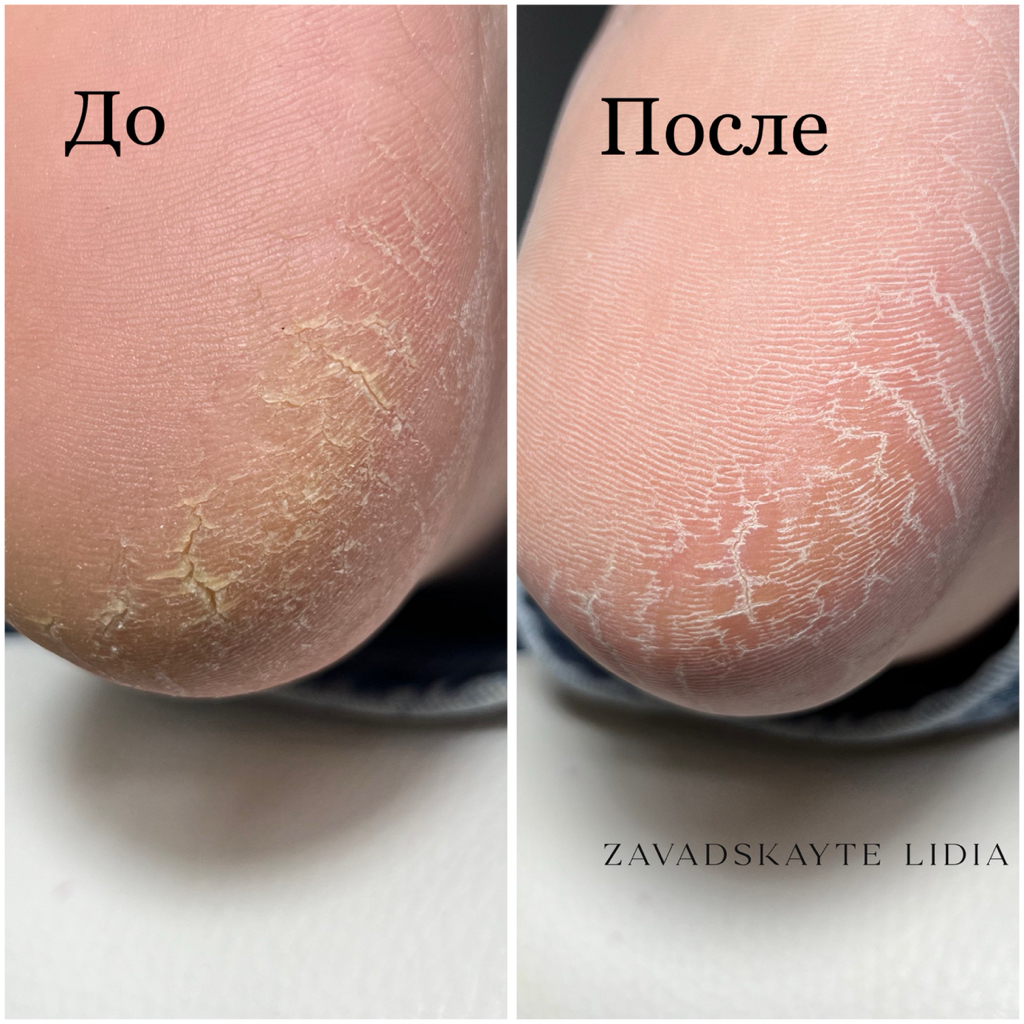 Полный аппаратный педикюр