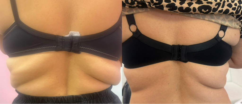 Стройность (BioGel)