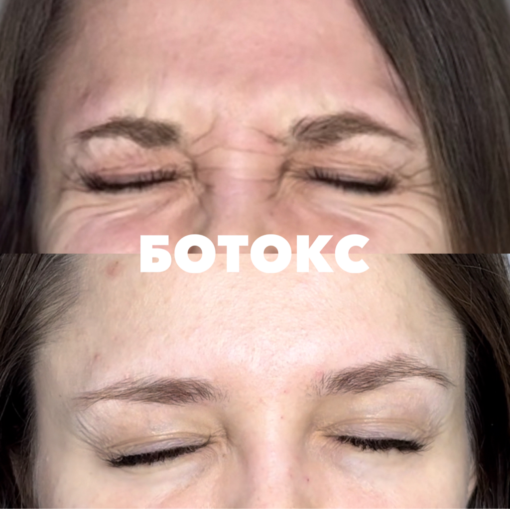 Ботулинотерапия (любые зоны)
