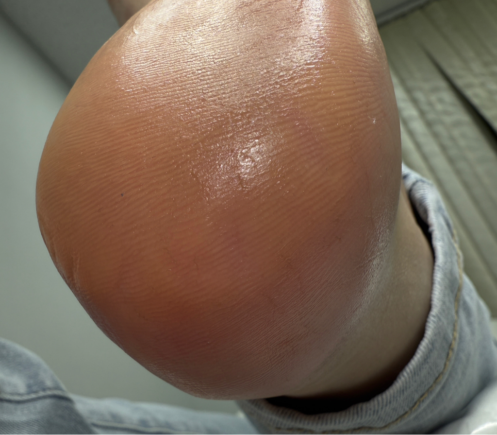 SMARTICURE БЕЗ покрытия