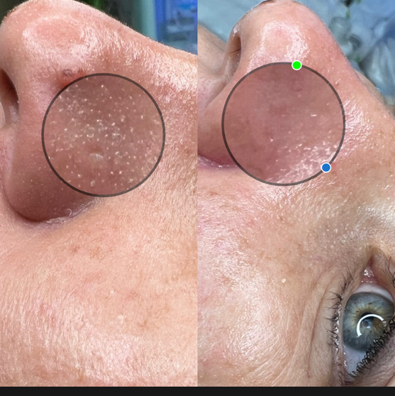 Комбинированная чистка лица COMODEX