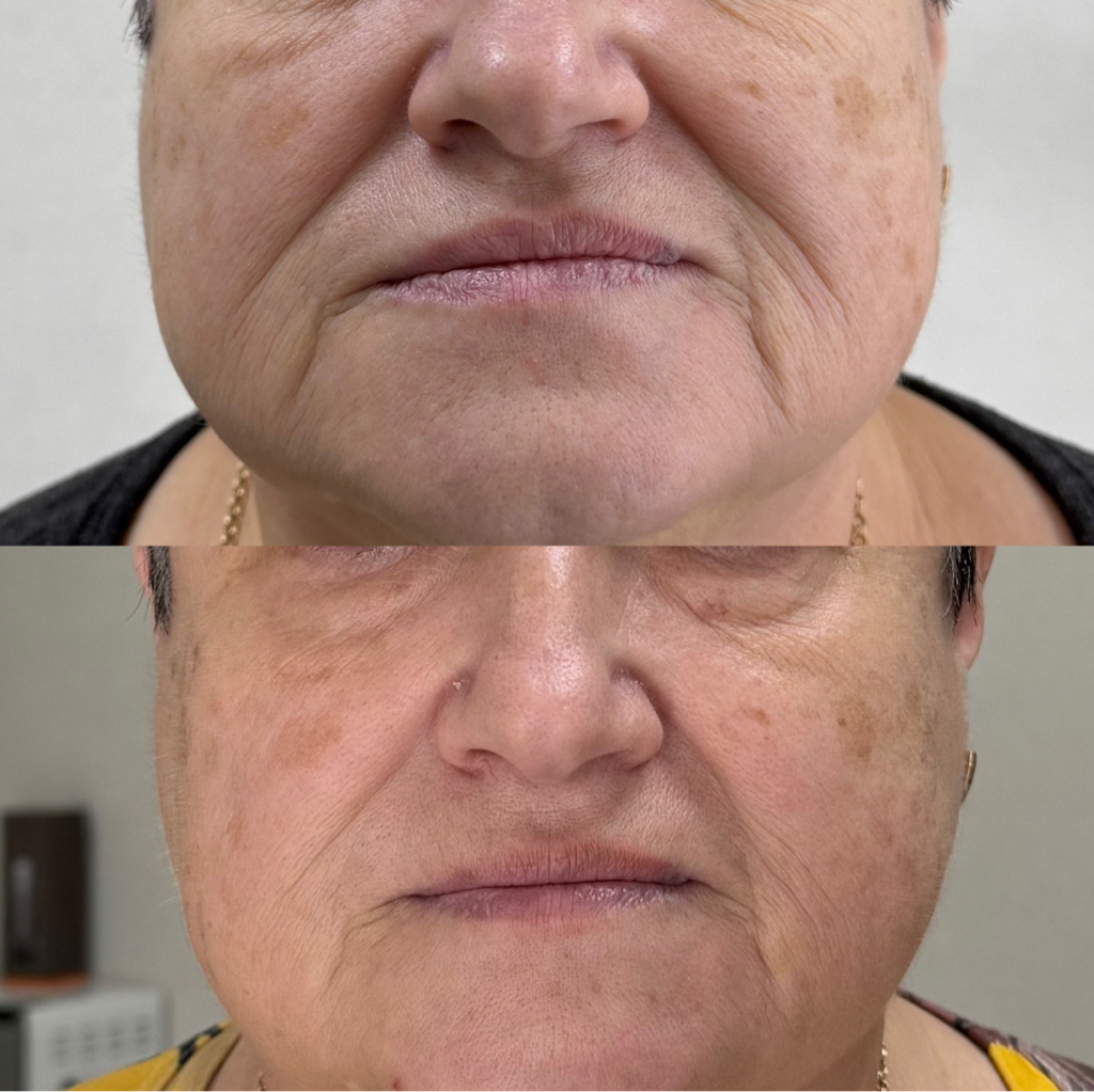 Нижняя треть лица