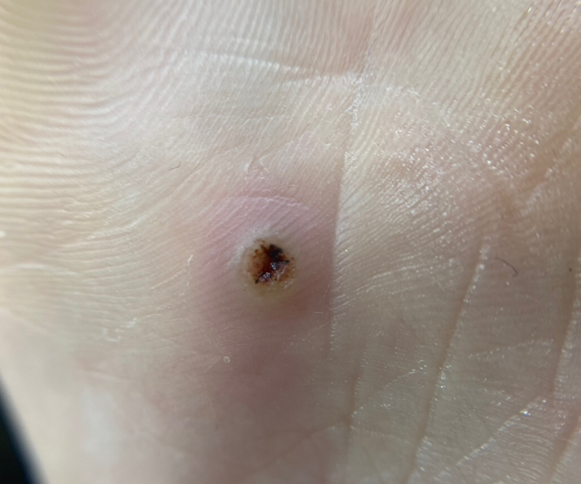 Удаление подошвенной бородавки