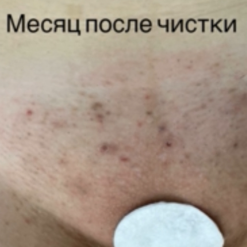 Интимный пилинг