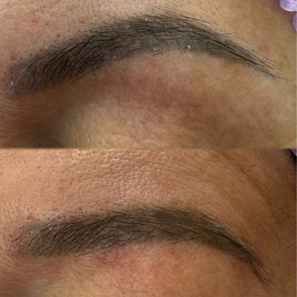 Коррекция реконструкции бровей