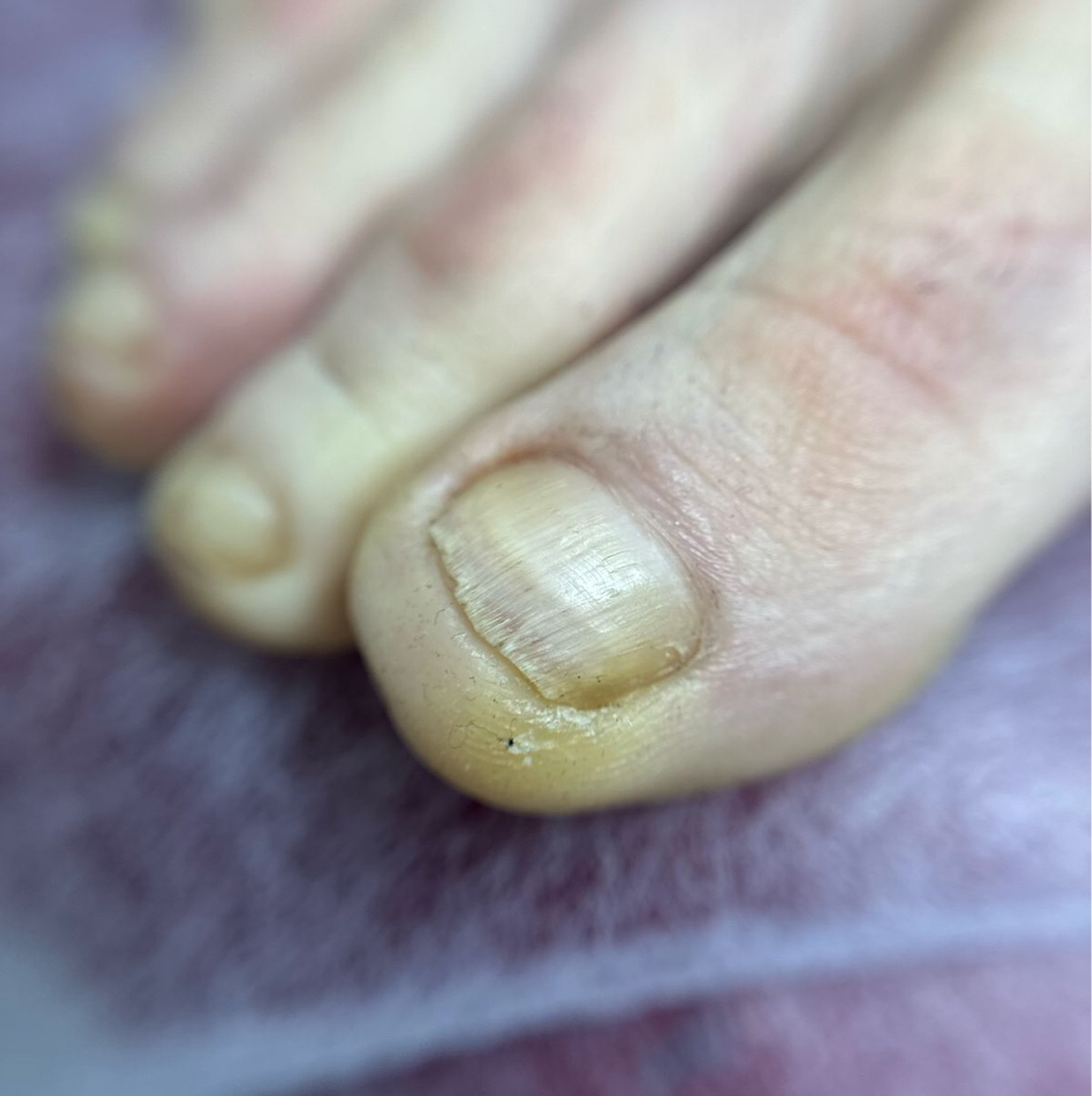 Подологический педикюр повышенной сложности 4000-6000